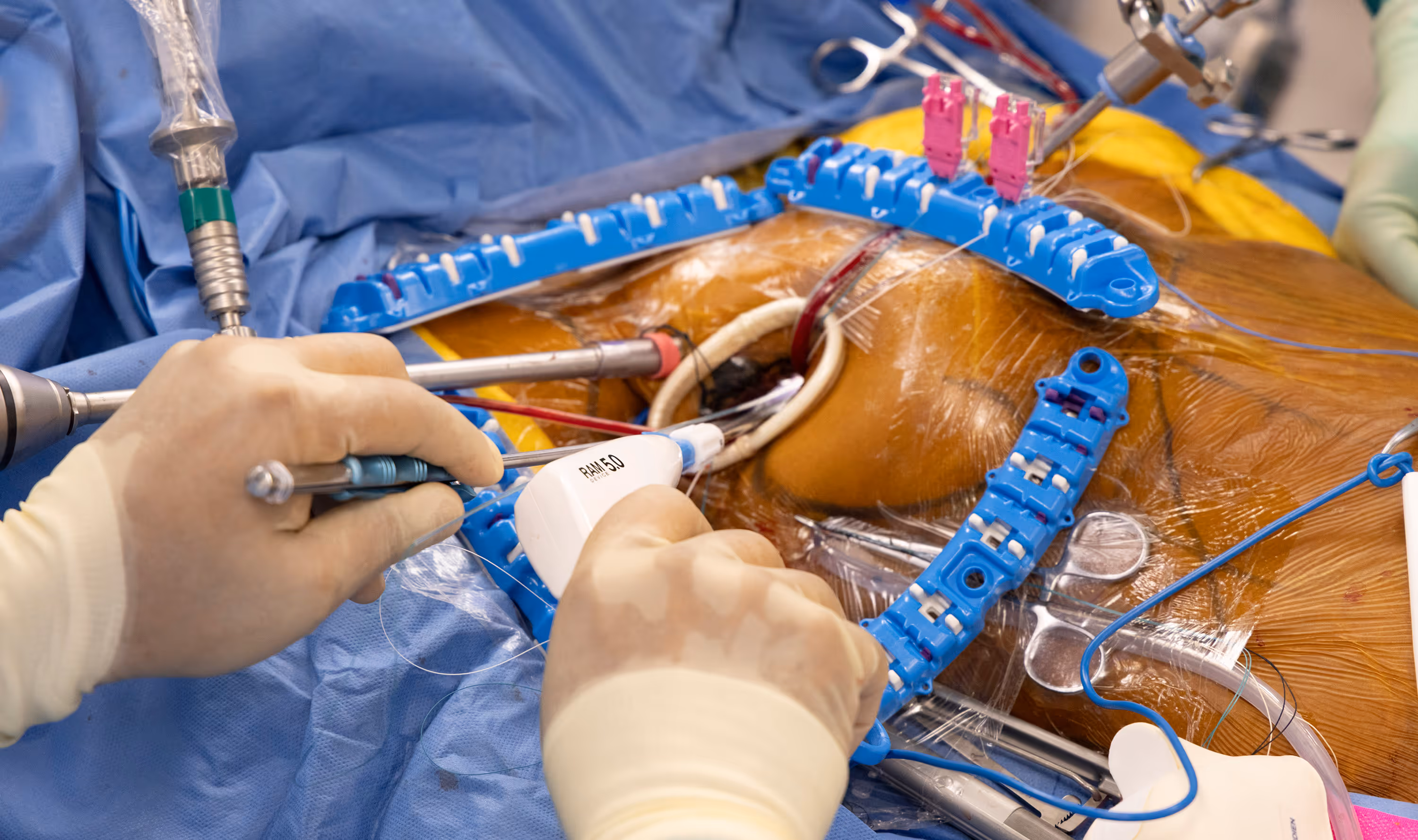 MVR Annular Suturing