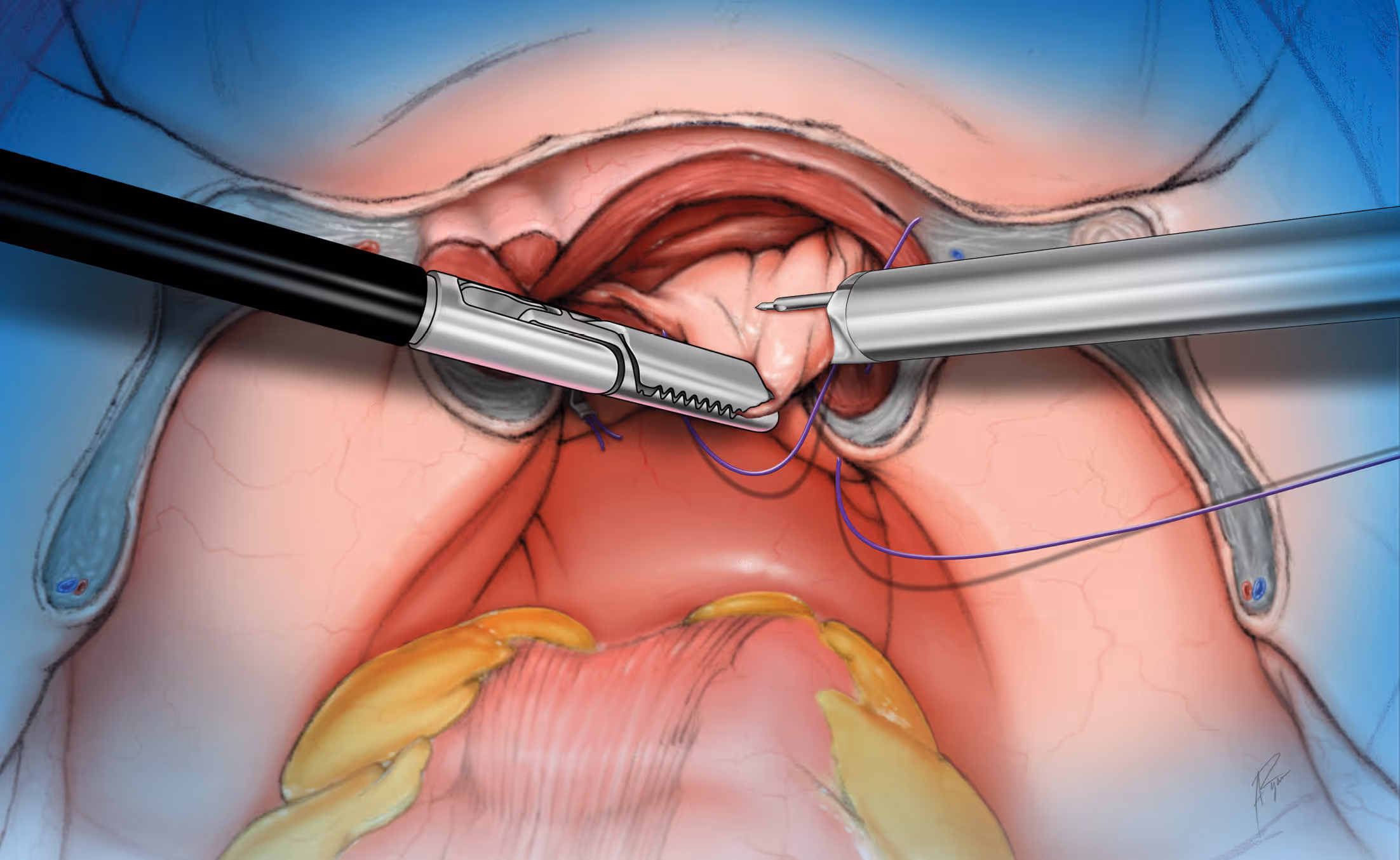 Cuff Closure LSI Solutions Illustration by Anthony Ryan
