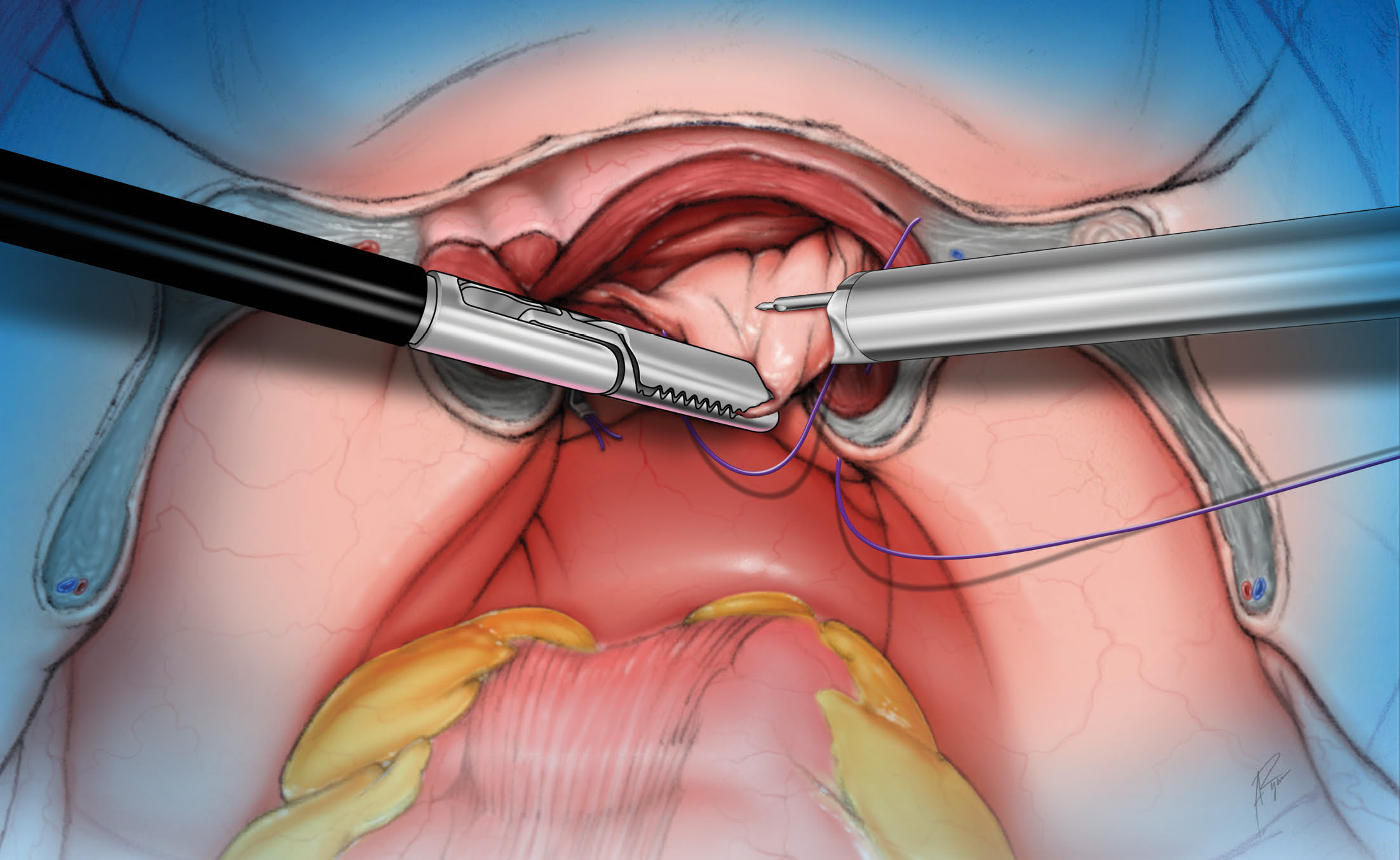 Cuff Closure LSI Solutions Illustration by Anthony Ryan