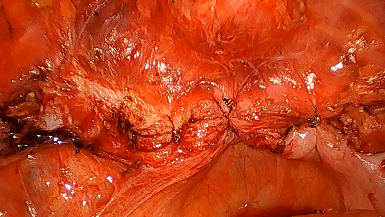 Fast and Effective Vaginal Cuff Closure with RD180 and Ti-KNOT by LSI Solutions