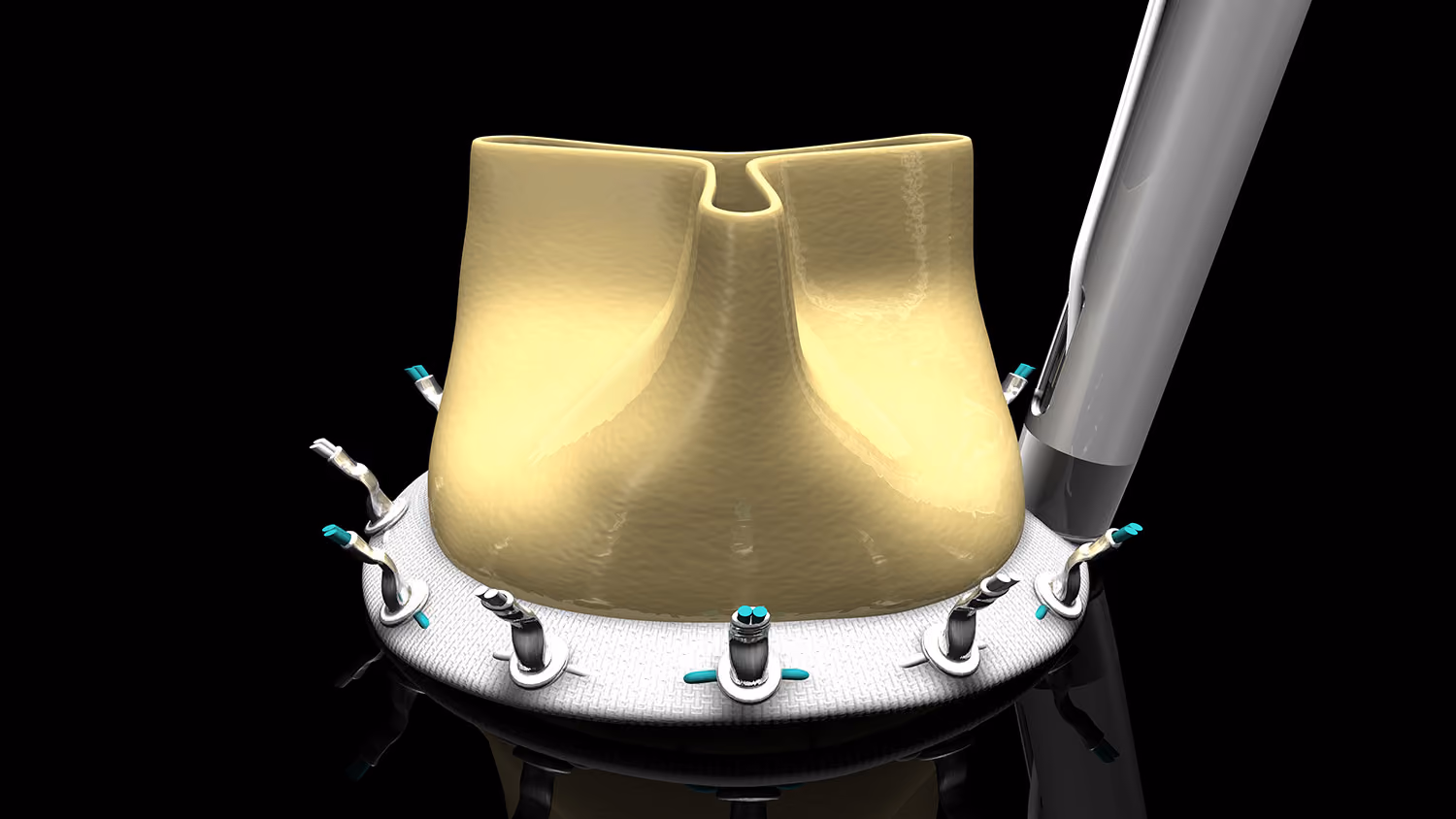 Heart Valve using LSI SOLUTIONS COR-KNOT Titanium Fastener