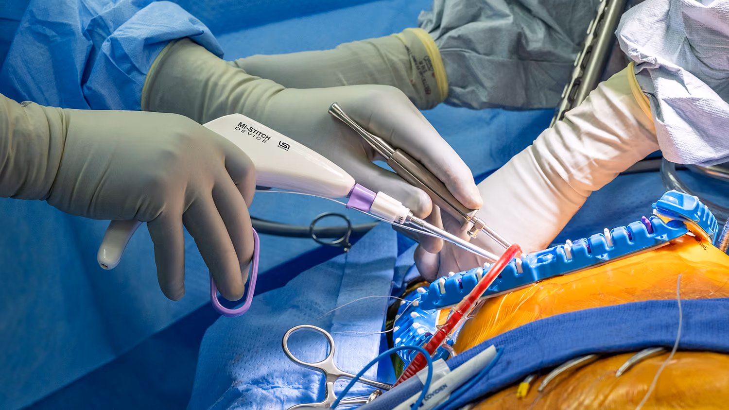 μMVr using Mi-STITCH device by LSI Solutions