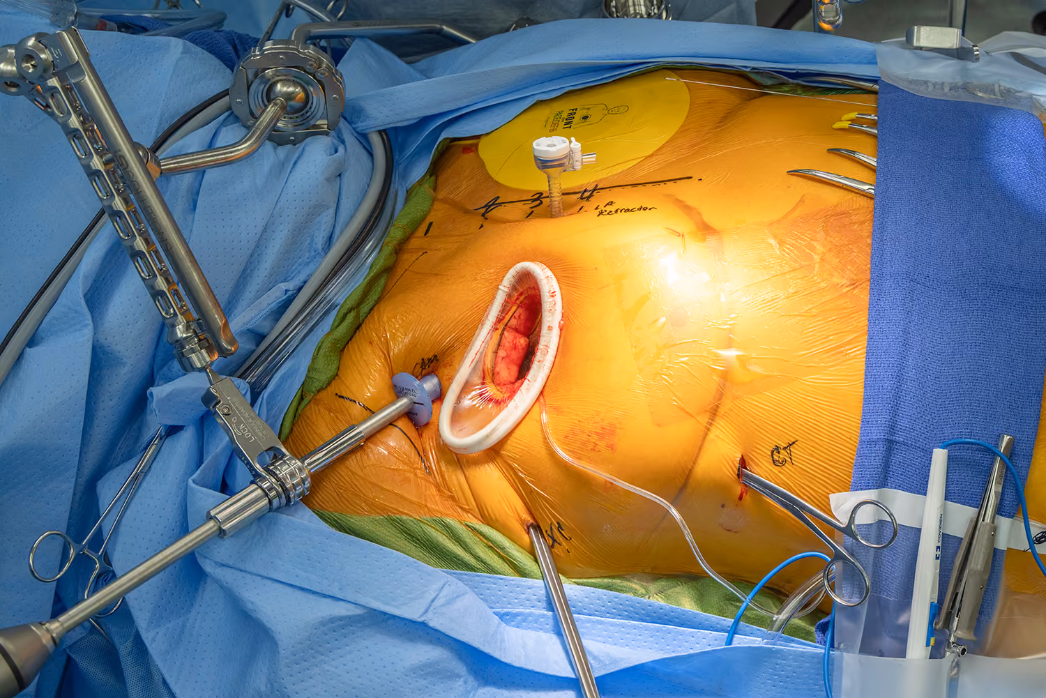 μMVr Procedure by Dr. DeFrain