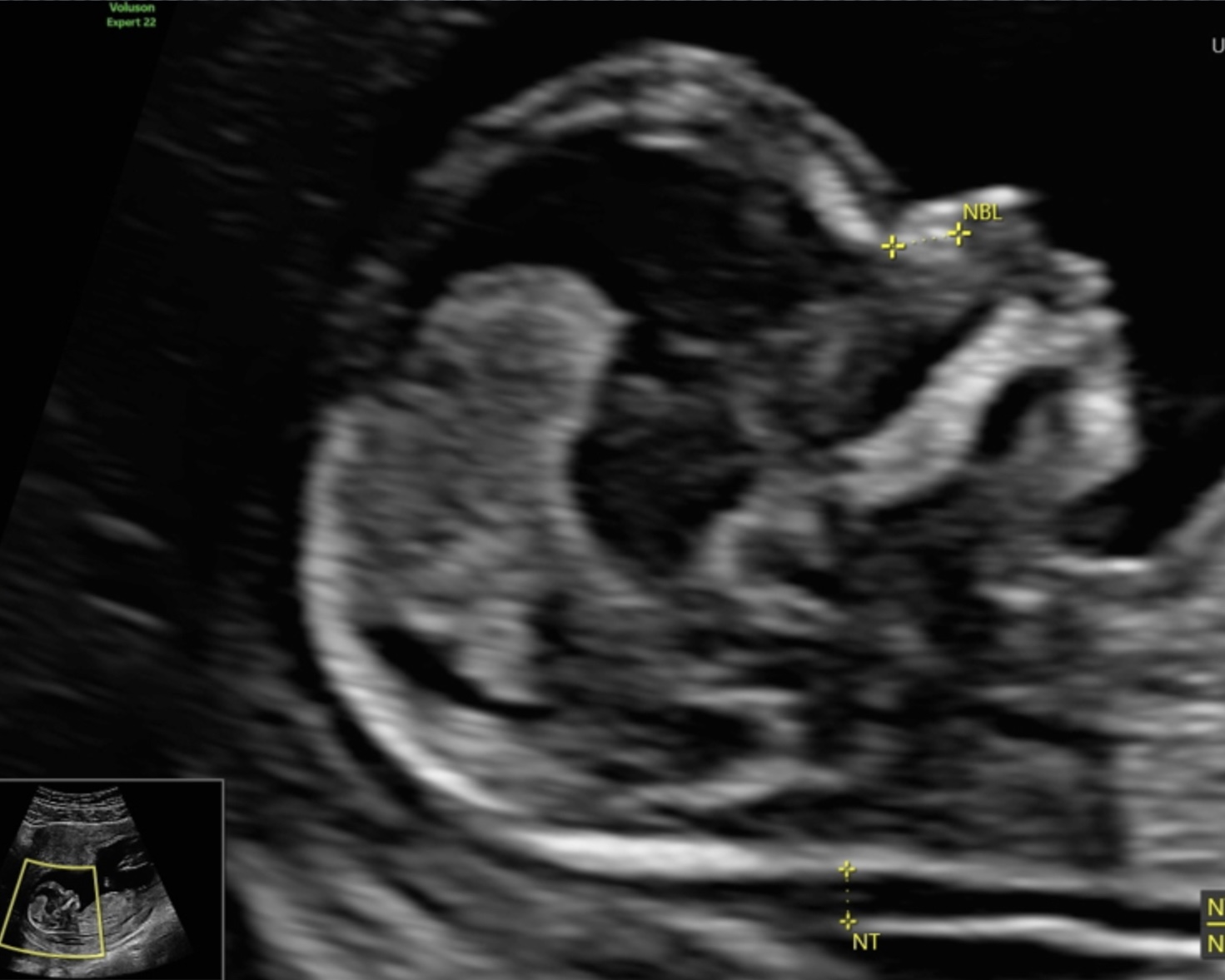 Nackentransparenzmessung, 1. Trimester (unauffällig)