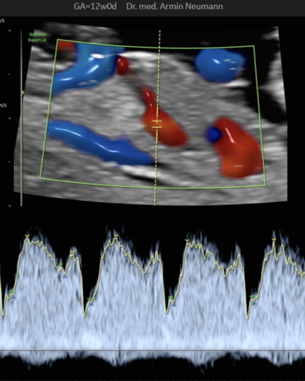 Blutfluss im Ductus venosus, 1. Trimester