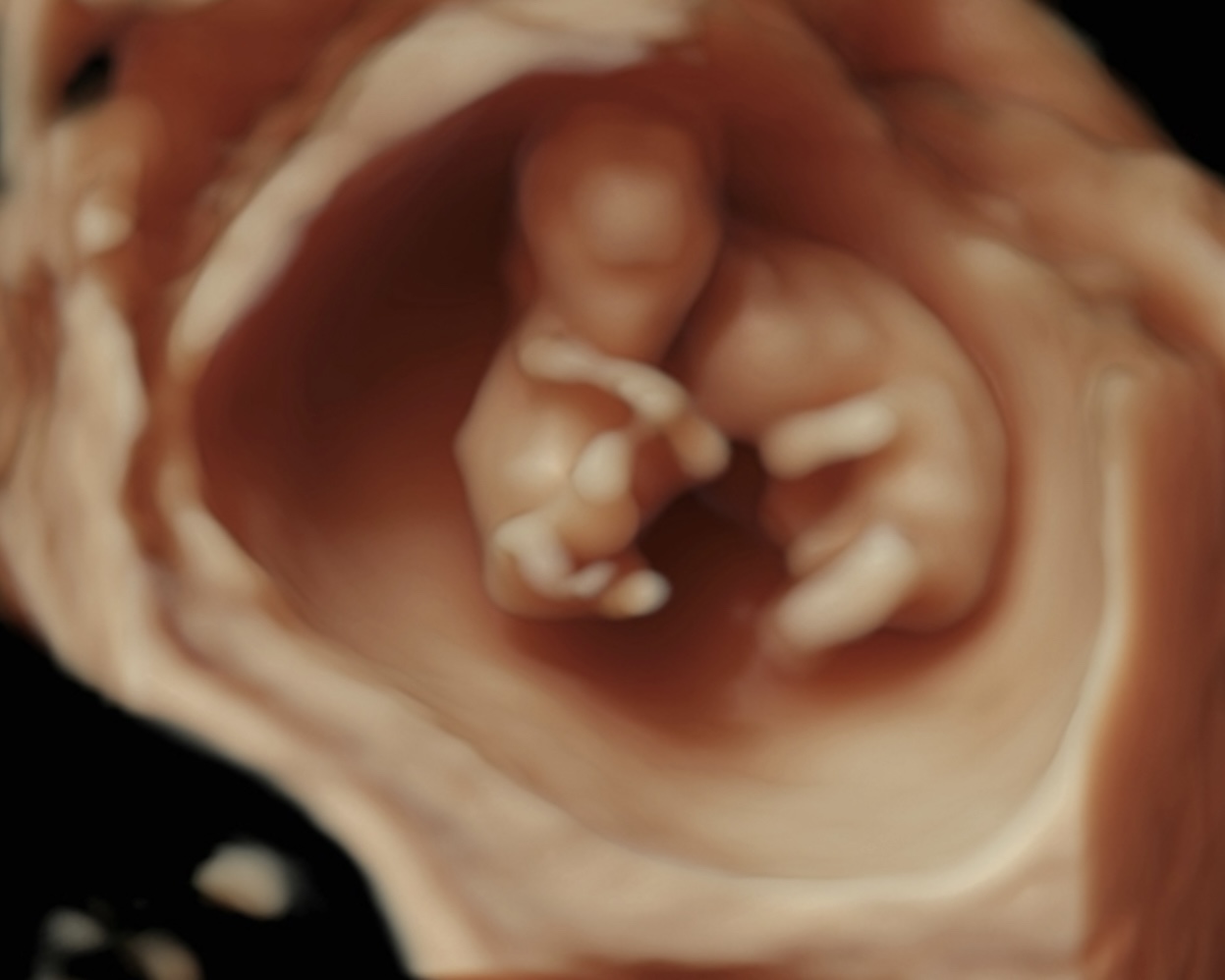 Zwillinge, 3D, 1. Trimester 