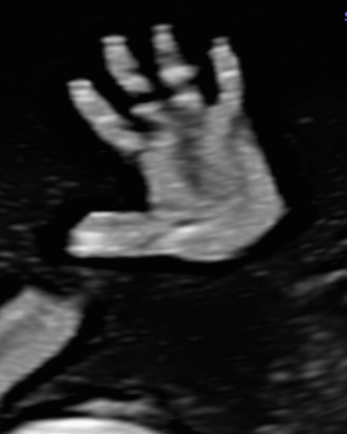 Fetale Hand, 2. Trimester