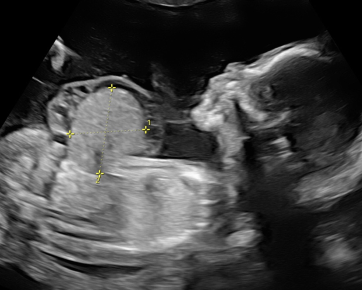 Fetus mit Bauchnabelbruch (Omphalocele), 1. Trimester 