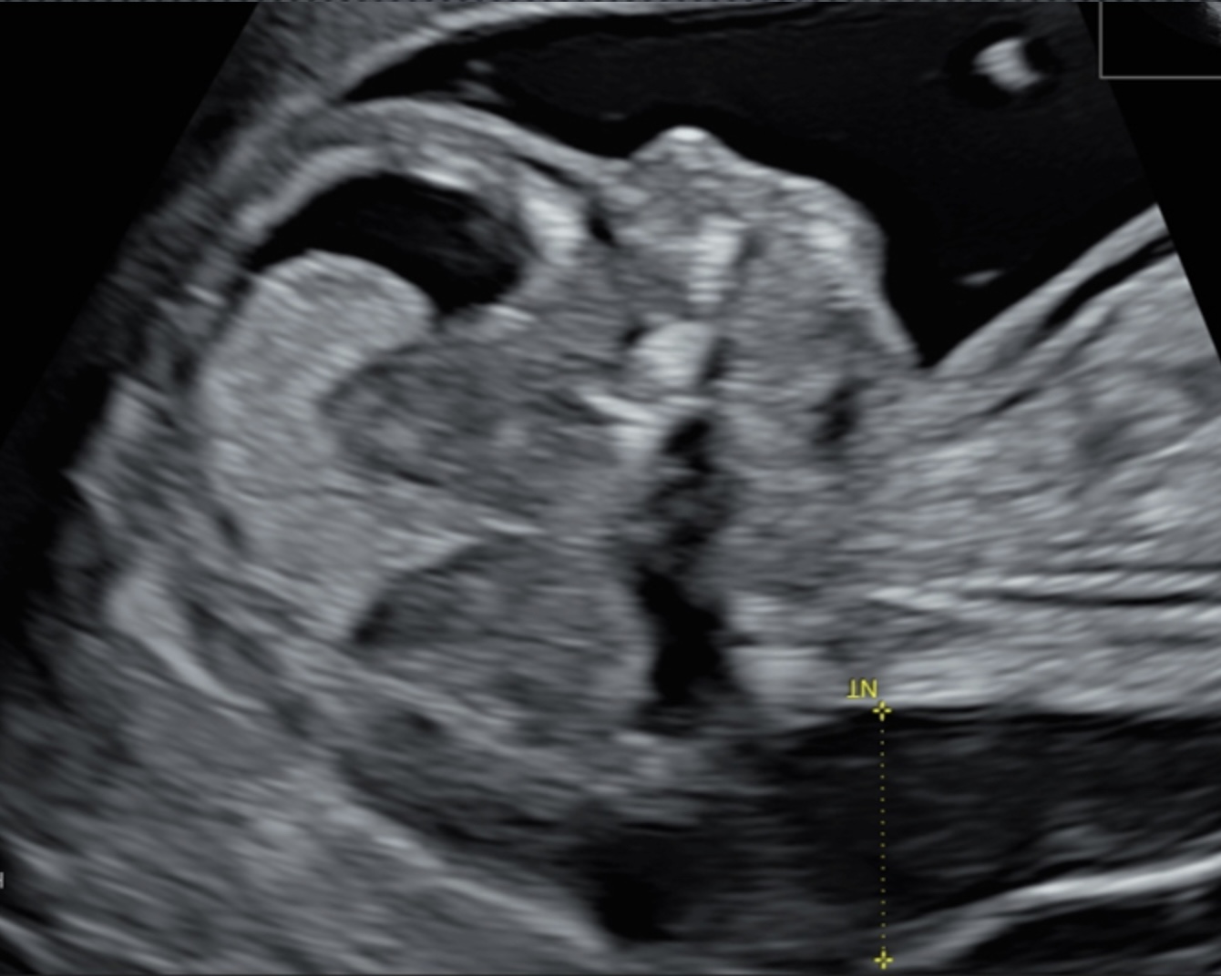 Erhöhte Nackentransparenz, 1. Trimester (auffällig)