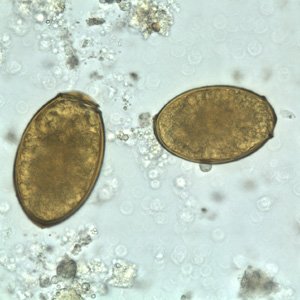 Parasitology Spotlight: Paragonimus thumbnail