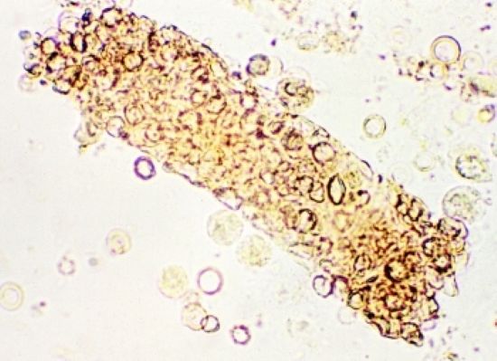 Urine Casts: RBC Cast thumbnail