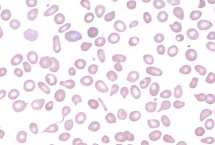 Beta Thalassemia thumbnail