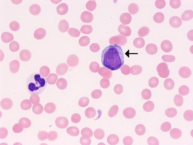 Myelodysplastic Neoplasms (MDS) thumbnail