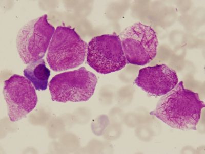 Leukemia Case Studies: Acute and Chronic Leukemias thumbnail