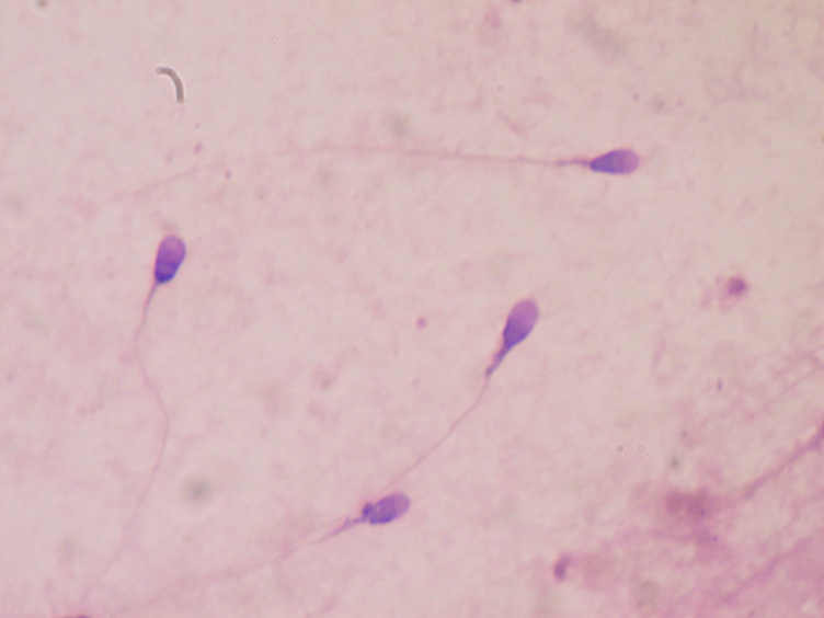 Semen Analysis thumbnail