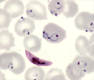 Malaria thumbnail