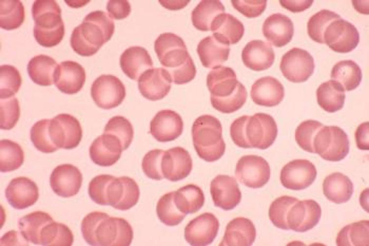 Erythrocyte Inclusions thumbnail