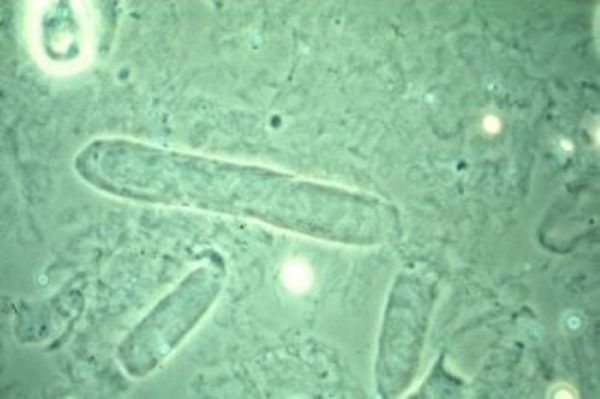 Urine Casts: Hyaline Cast thumbnail