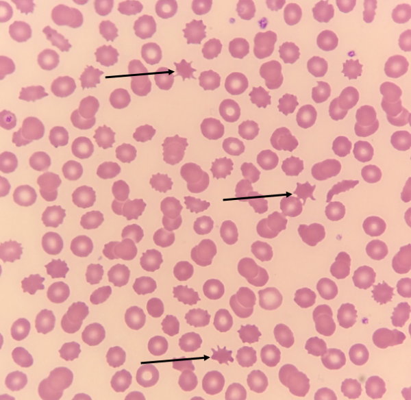 Red Blood Cell Morphology: Acanthocyte thumbnail