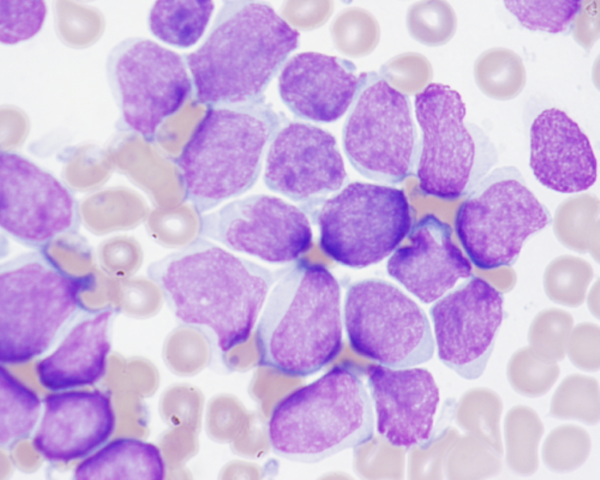 Case Studies in Pediatric Hematology thumbnail