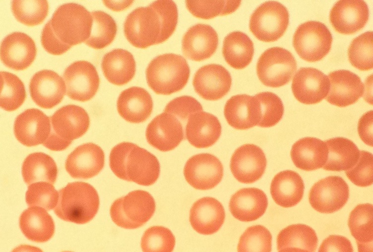 Red Blood Cell (RBC) Morphology thumbnail
