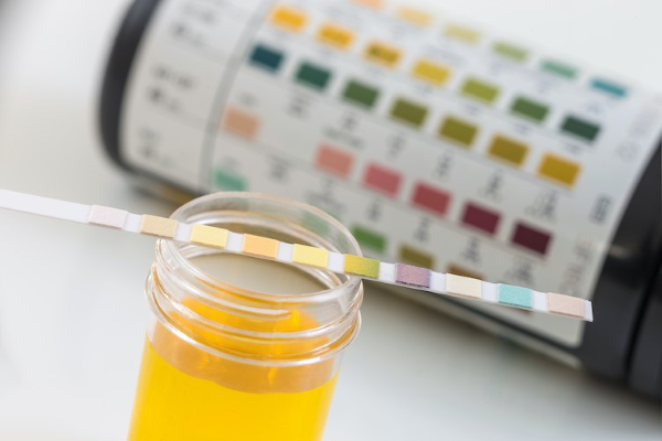 Chemical Screening of Urine by Reagent Strip thumbnail