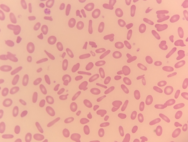Red Blood Cell Morphology: Elliptocyte thumbnail