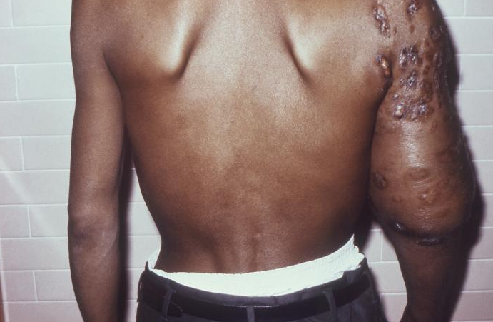 Medically Important Aerobic Actinomycetes thumbnail
