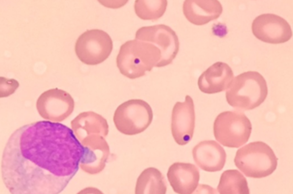 Red Blood Cell Inclusions: Howell-Jolly Body thumbnail