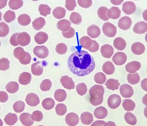 Case Studies in Hematology - Nonmalignant WBC Disorders thumbnail
