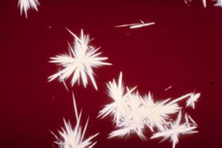 The Urine Microscopic: Microscopic Analysis of Urine Sediment thumbnail