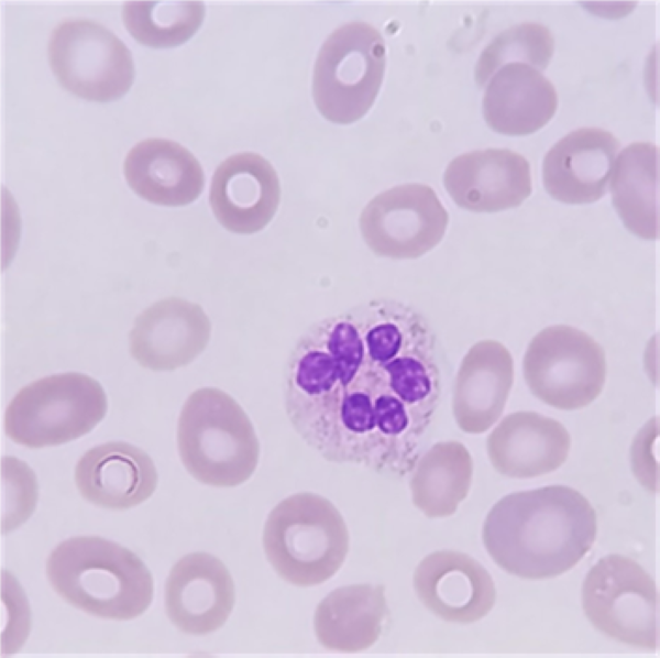 Macrocytic Anemias thumbnail
