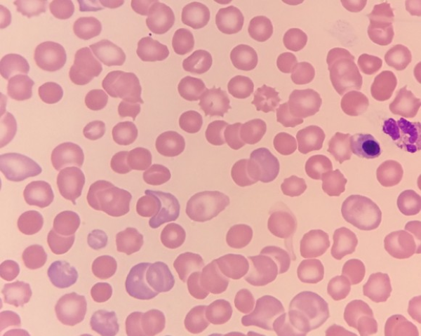 Red Blood Cell Morphology: Spherocyte thumbnail