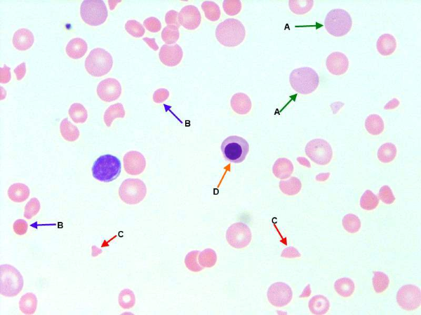 Immune Hemolytic Anemias thumbnail