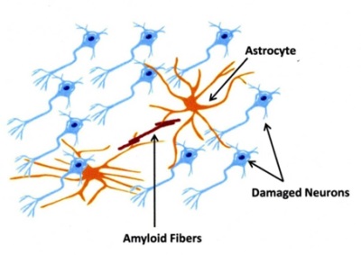 Overview of Prion Diseases thumbnail