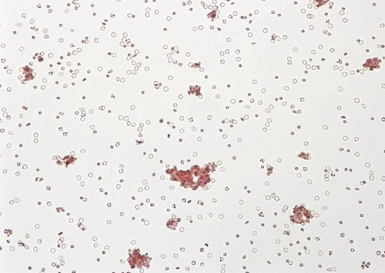 The Disappearing Antibody: A Case Study thumbnail