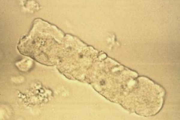 Urine Casts: Waxy Cast thumbnail