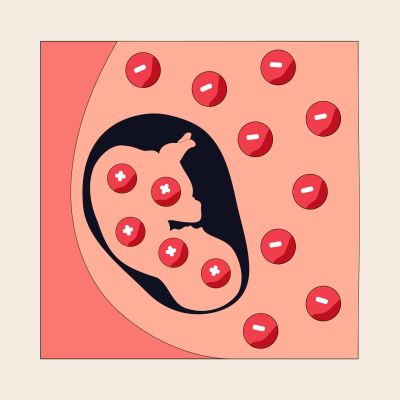 Hemolytic Disease of the Fetus and Newborn thumbnail