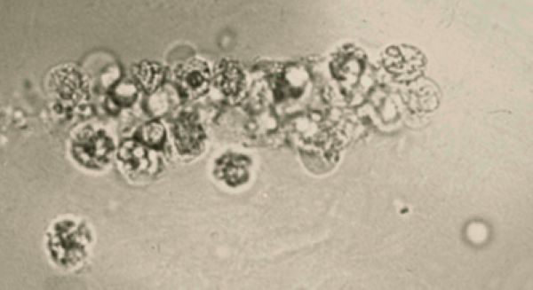 Urine Casts: WBC Cast thumbnail