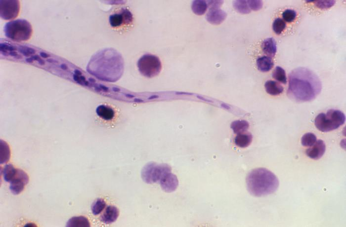 Microfilariae in Humans thumbnail