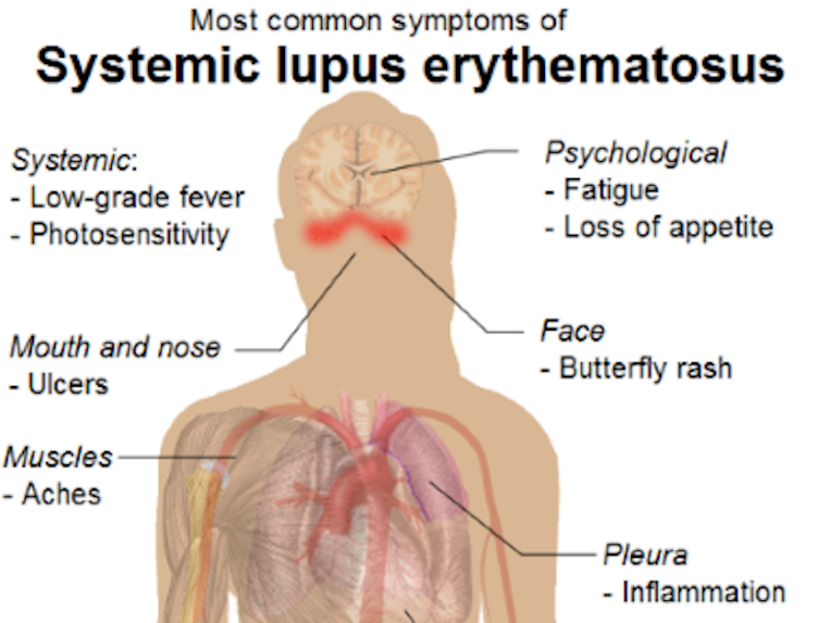 Laboratory Evaluation of the Lupus Anticoagulant found in Antiphospholipid Syndrome thumbnail