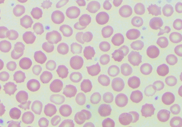 Describing a Red Blood Cell Population Using RBC Indices and Red Cell Distribution Width thumbnail