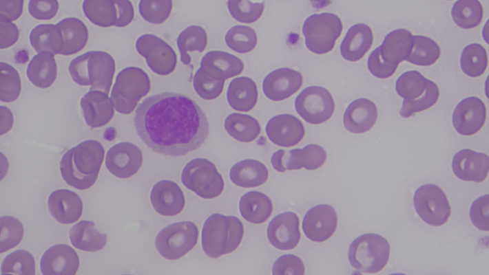 Microcytic Anemias thumbnail
