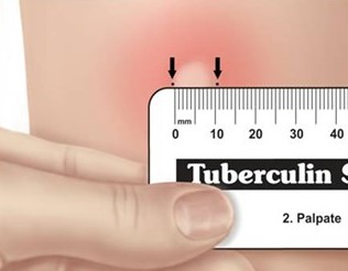 Latent Mycobacterium tuberculosis Infection and Laboratory Test Methods thumbnail