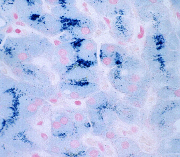 Hereditary Hemochromatosis thumbnail