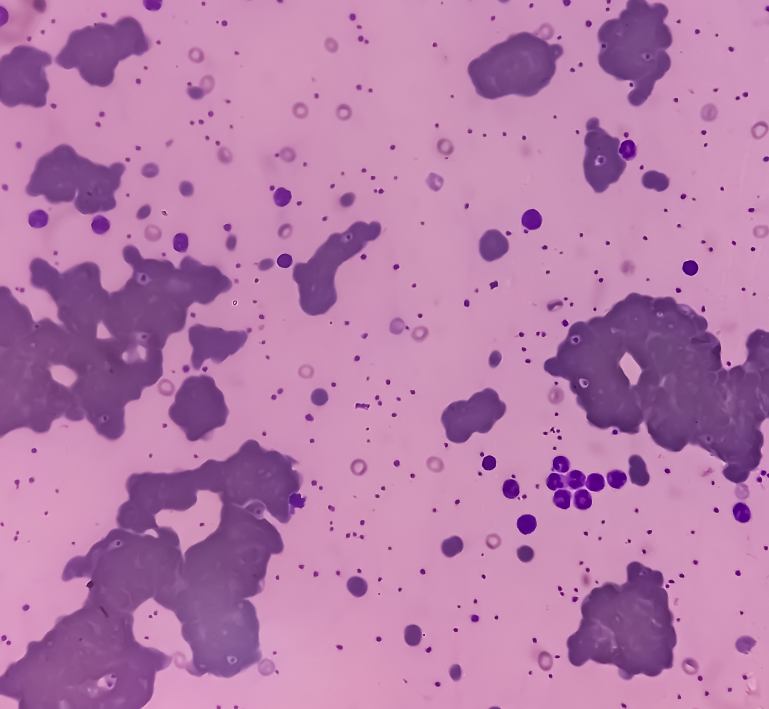 A Case of Cold Agglutinin Disease thumbnail