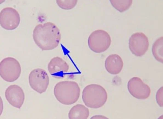 Red Blood Cell Inclusions: Pappenheimer Bodies thumbnail