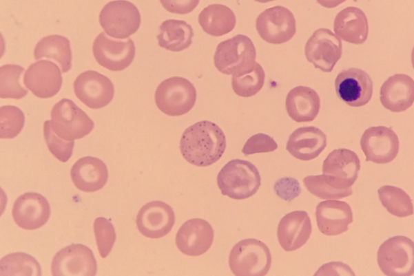 Red Blood Cell Inclusions: Basophilic Stippling thumbnail