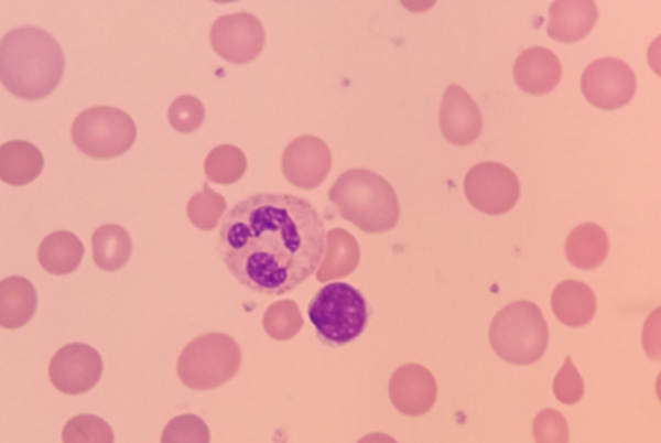 Anisocytosis thumbnail