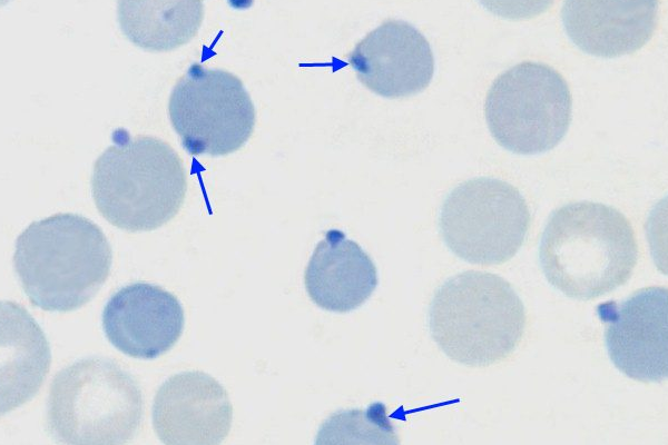Red Blood Cell Inclusions: Heinz Body thumbnail